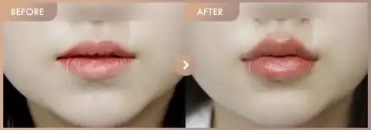 Lip filler: before-and-after comparison at Newstar Clinic