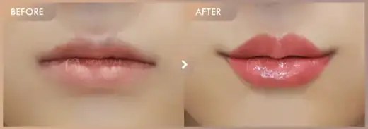 Lip filler: before-and-after comparison at Newstar Clinic
