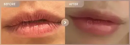 Lip filler: before-and-after comparison at Newstar Clinic