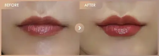 Lip fillers: before-and-after comparison at Newstar Clinic