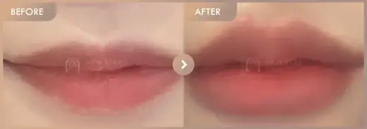 Lip fillers: before-and-after comparison at Newstar Clinic