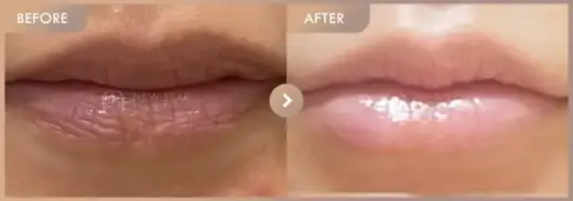 Lip filler: before-and-after comparison at Newstar Clinic