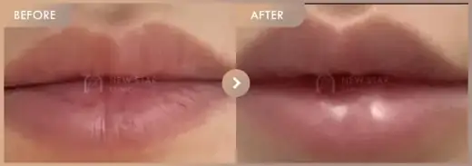 Lip filler: before-and-after comparison at Newstar Clinic