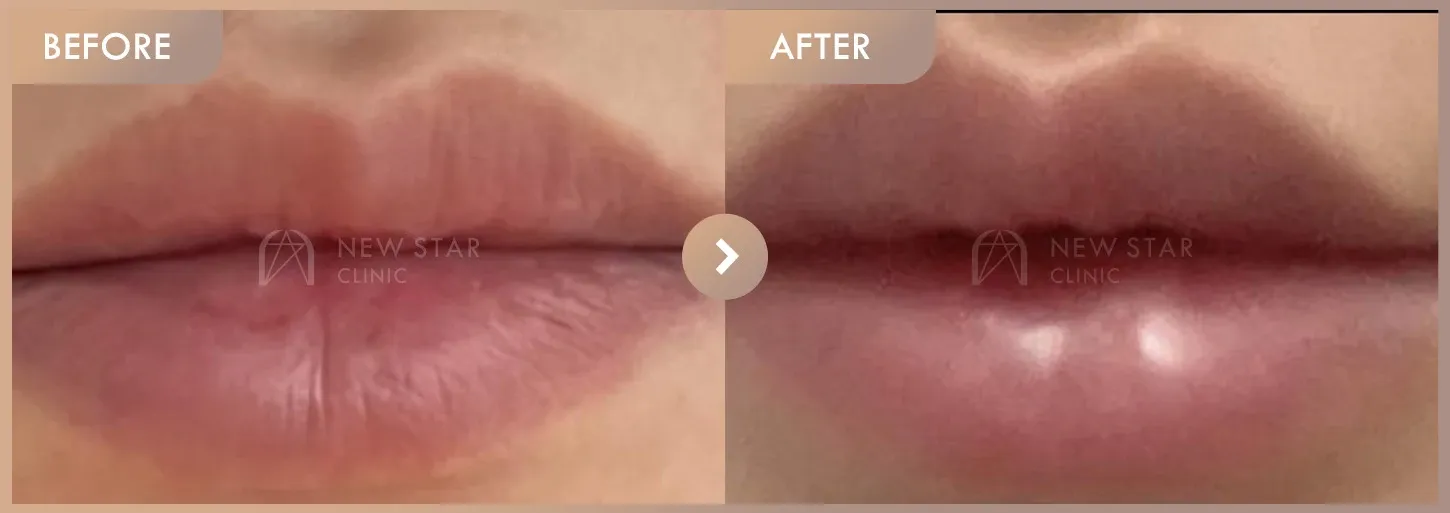 Lip filler before-and-after photos at Newstar Clinic