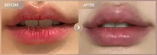 Lip filler: before-and-after comparison at Newstar Clinic