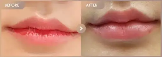 Lip filler: before-and-after comparison at Newstar Clinic