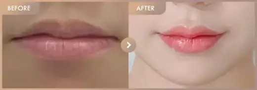 Lip fillers: before-and-after comparison at Newstar Clinic