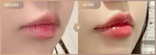 Lip filler: before-and-after comparison at Newstar Clinic