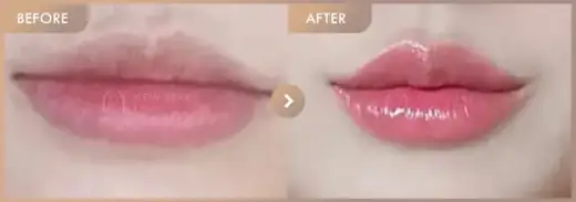 Lip filler: before-and-after comparison at Newstar Clinic
