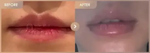 Lip filler: before-and-after comparison at Newstar Clinic