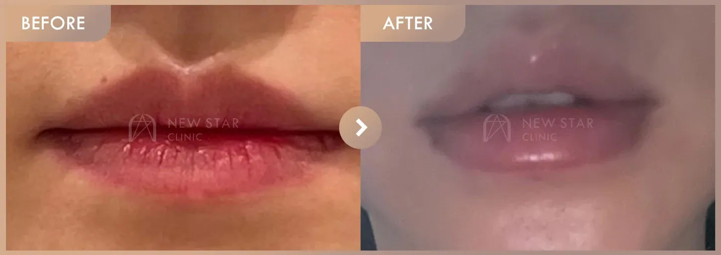 Lip filler before-and-after photos at Newstar Clinic