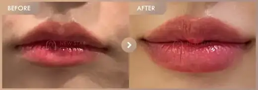 Lip fillers: before-and-after comparison at Newstar Clinic