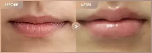 Lip filler: before-and-after comparison at Newstar Clinic