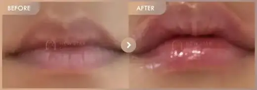 Lip filler: before-and-after comparison at Newstar Clinic