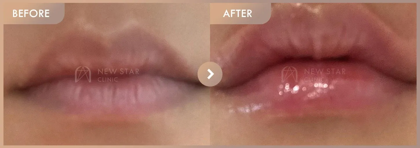 Lip filler before-and-after photos at Newstar Clinic