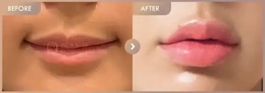 Lip filler: before-and-after comparison at Newstar Clinic