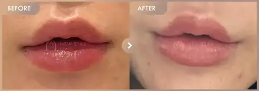 Lip filler: before-and-after comparison at Newstar Clinic