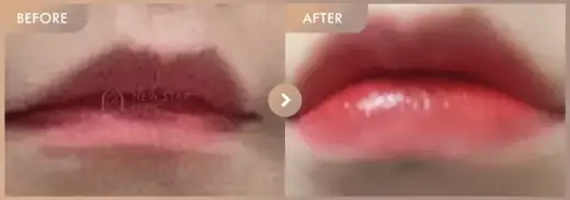 Lip filler: before-and-after comparison at Newstar Clinic