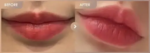 Lip fillers: before-and-after comparison at Newstar Clinic