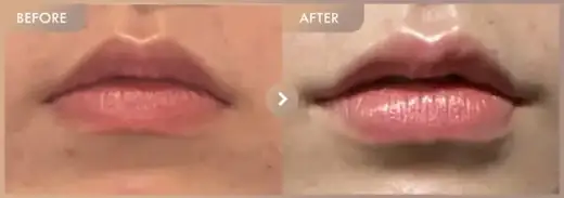 Lip filler: before-and-after comparison at Newstar Clinic