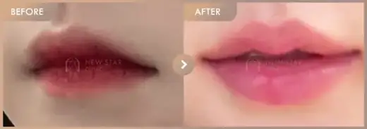 Lip fillers: before-and-after comparison at Newstar Clinic
