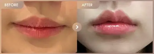 Lip filler: before-and-after comparison at Newstar Clinic