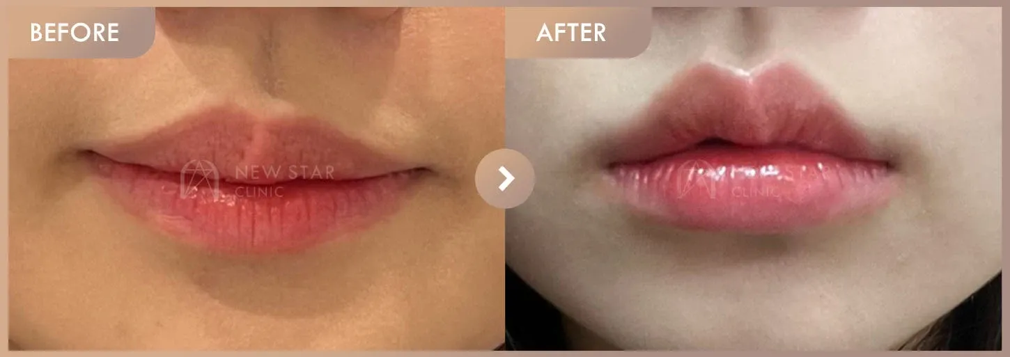 Lip filler before-and-after photos at Newstar Clinic