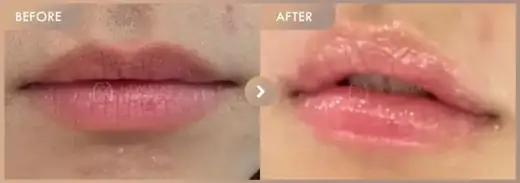 Lip filler: before-and-after comparison at Newstar Clinic