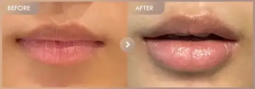 Lip filler: before-and-after comparison at Newstar Clinic