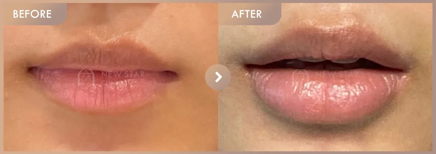 Lip filler before-and-after photos at Newstar Clinic