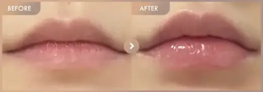 Lip filler: before-and-after comparison at Newstar Clinic
