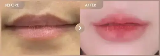 Lip filler: before-and-after comparison at Newstar Clinic