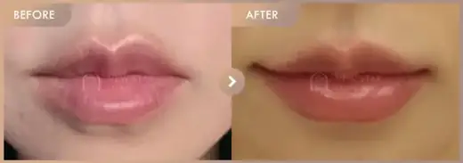 Lip filler: before-and-after comparison at Newstar Clinic