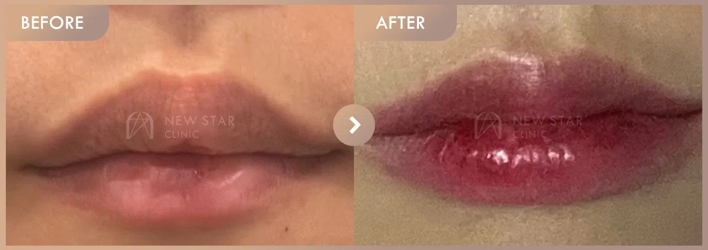 Lip filler before-and-after photos at Newstar Clinic