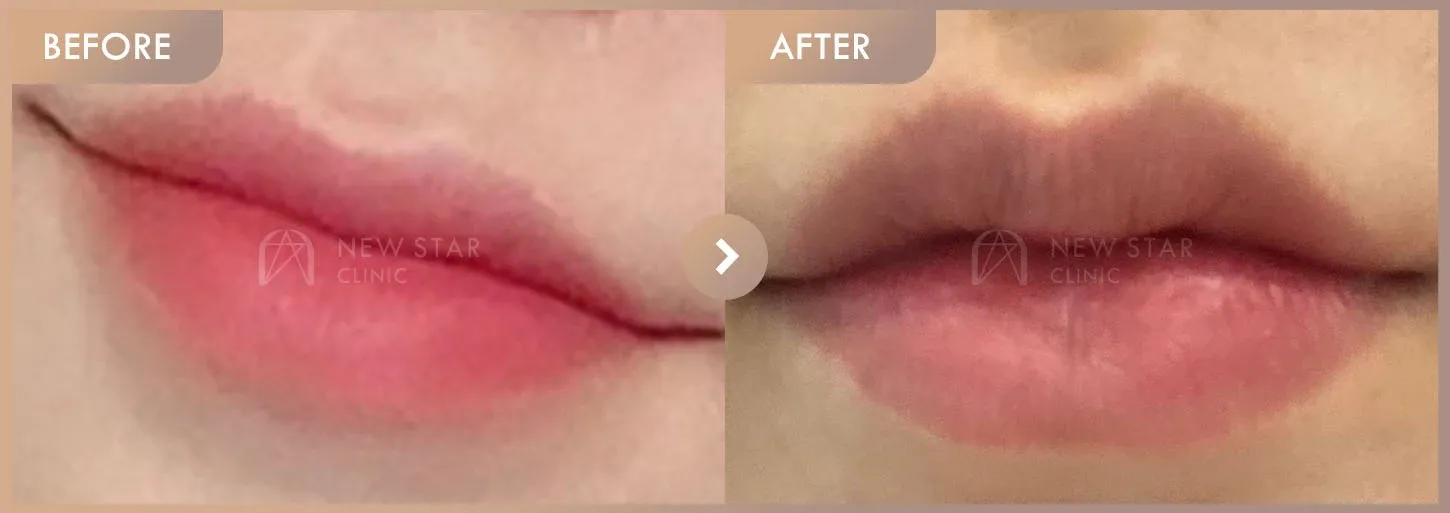 Lip filler before-and-after photos at Newstar Clinic