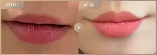 Lip filler: before-and-after comparison at Newstar Clinic