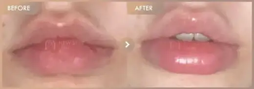 Lip filler: before-and-after comparison at Newstar Clinic