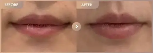 Lip filler: before-and-after comparison at Newstar Clinic