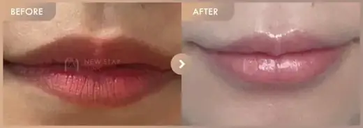 Lip filler: before-and-after comparison at Newstar Clinic