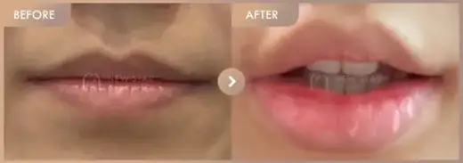 Lip filler: before-and-after comparison at Newstar Clinic