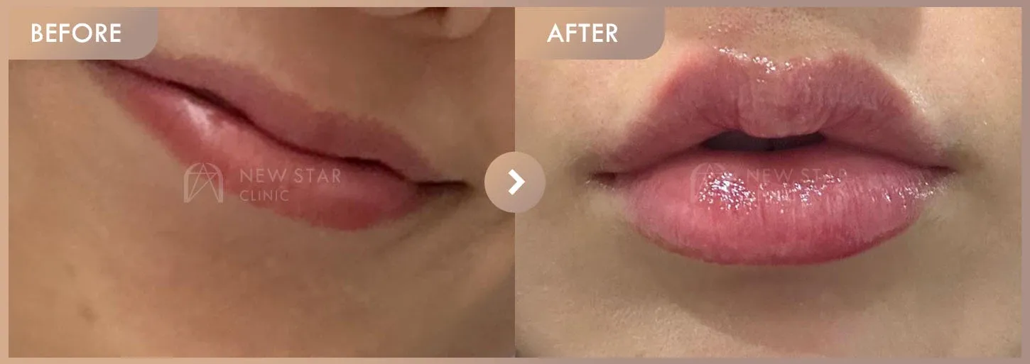Lip filler before-and-after photos at Newstar Clinic