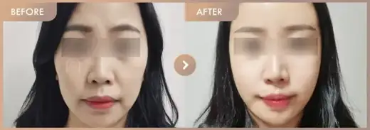 full-face filler + Lip filler: before-and-after comparison at Newstar Clinic