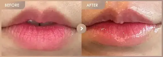 Lip filler: before-and-after comparison at Newstar Clinic