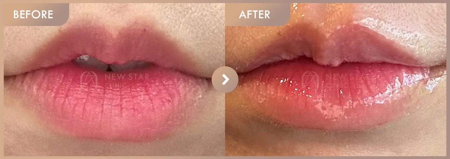 Lip filler before-and-after photos at Newstar Clinic