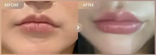 Lip fillers: before-and-after comparison at Newstar Clinic