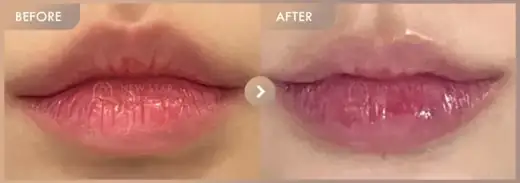 Lip filler: before-and-after comparison at Newstar Clinic