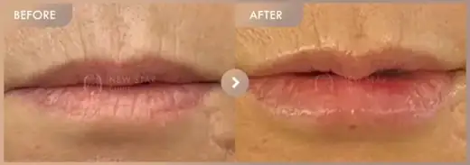 Lip filler: before-and-after comparison at Newstar Clinic