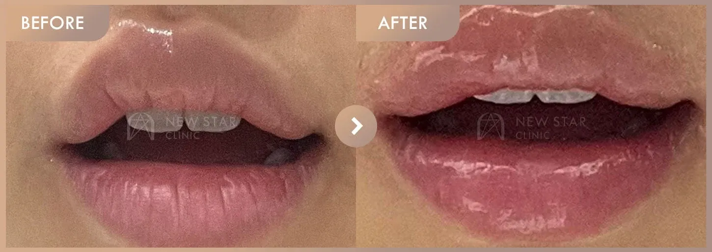 Lip filler before-and-after photos at Newstar Clinic