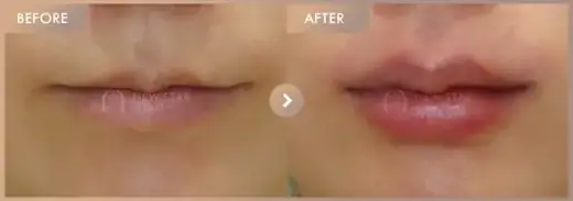 Lip fillers: before-and-after comparison at Newstar Clinic