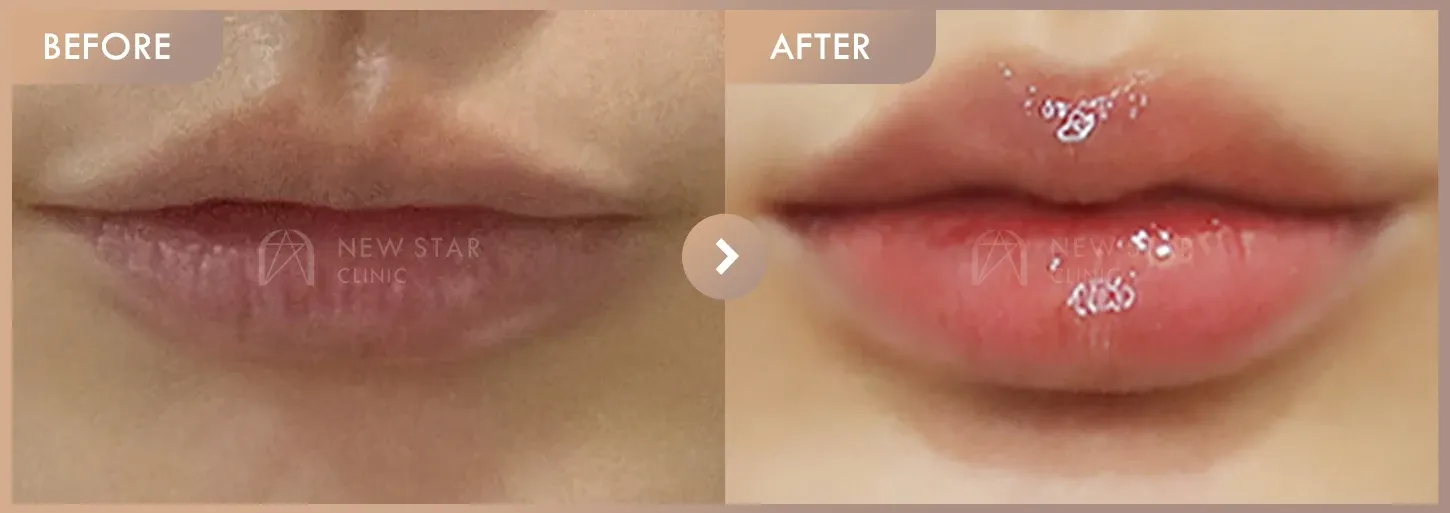 Lip fillers before-and-after photos at Newstar Clinic